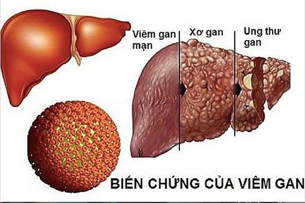 Hầu hết những triệu chứng sớm của loại ung thư phổ biến nhất ở nam giới đều bị bỏ qua