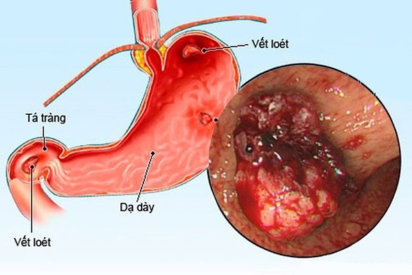 Phòng ngừa chứng loét dạ dày