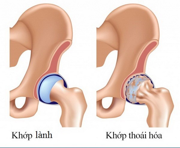 Phòng thoái hóa khớp háng