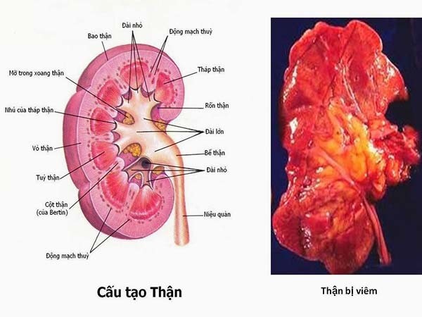 Dấu hiệu viêm cầu thận cấp