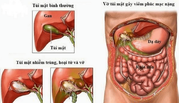 Tìm căn nguyên gây viêm phúc mạc