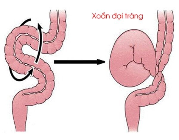 Xoắn đại tràng cần phát hiện sớm và chữa trị kịp thời