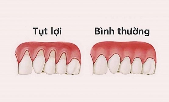 Hậu quả đáng ngại khi bị tụt lợi