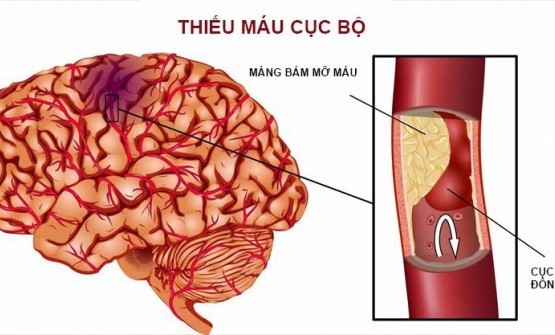 Cách phát hiện “kẻ thù nguy hiểm”- Cục máu đông