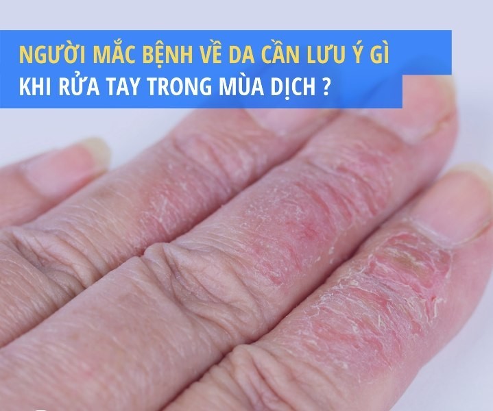 Người mắc bệnh về da cần lưu ý gì khi rửa tay trong mùa dịch?