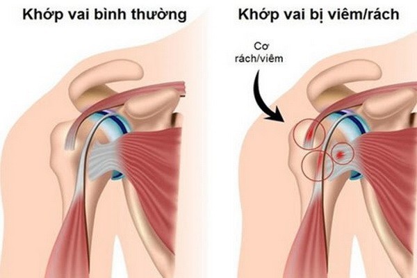 Ứng phó với viêm quanh khớp vai