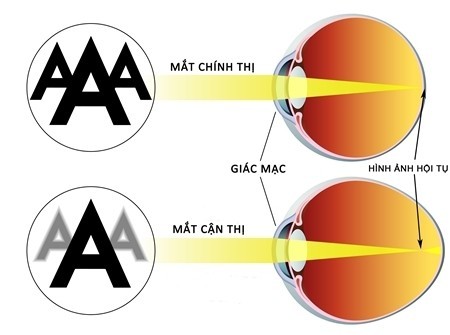 Các tật khúc xạ phổ biến ở trẻ em