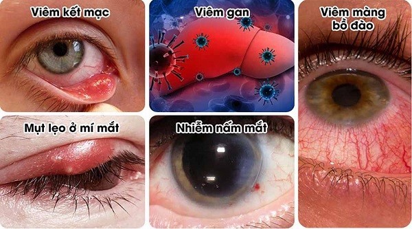 Co giật mí mắt, cảnh báo các bệnh về mắt