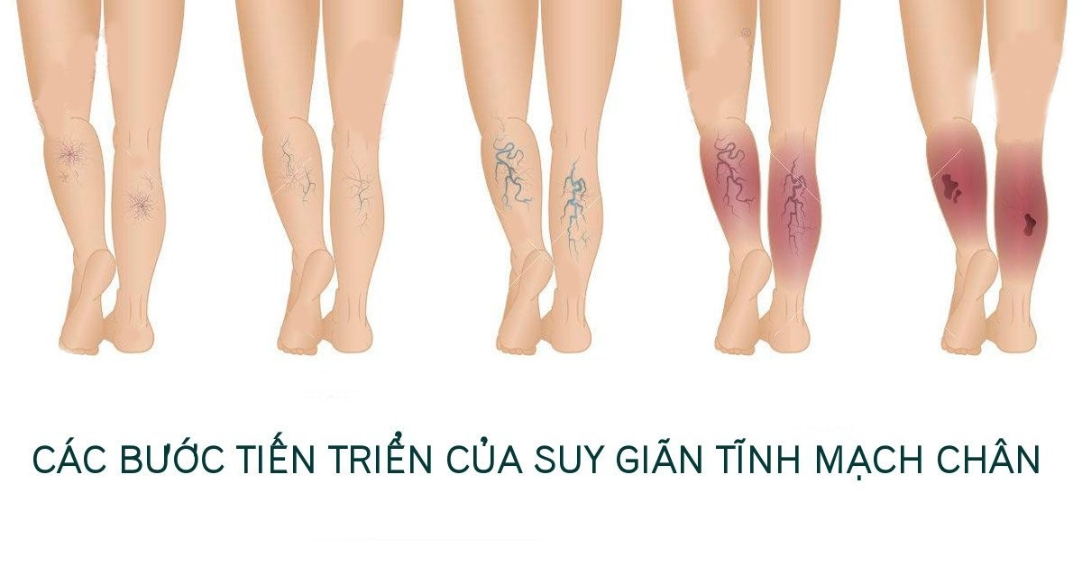 Bài tập cho người suy giãn tĩnh mạch chân