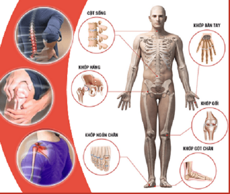 Thoái hóa khớp ngày càng trẻ hóa