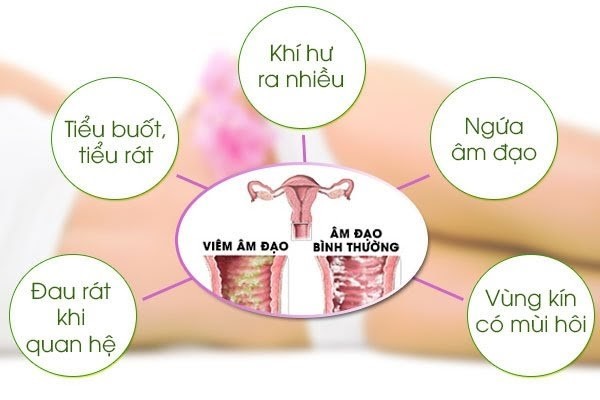 Ngừa viêm âm đạo ở phụ nữ