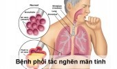 Phòng ngừa nguy cơ cho người bệnh phổi tắc nghẽn mạn tính trong đại dịch