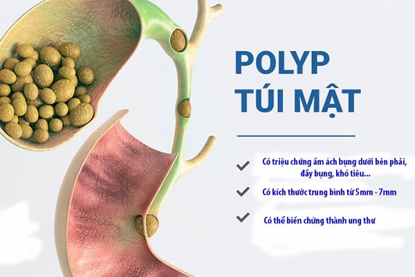 Yếu tố nguy cơ và triệu chứng polyp túi mật